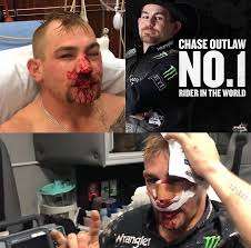 Who Was the Bull Rider That Got His Face Crushed? Courage, Recovery, and the Reality of Rodeo Risks 3 Chasw Outlaw injured